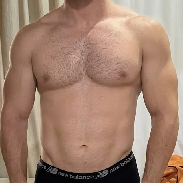 Depois: tronco de paciente masculino, de frente